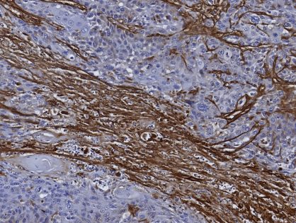 Immune cells held hostage in the tumor stroma!